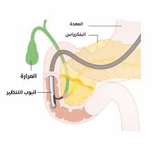 /تنظير القنوات المرارية والبنكرياس